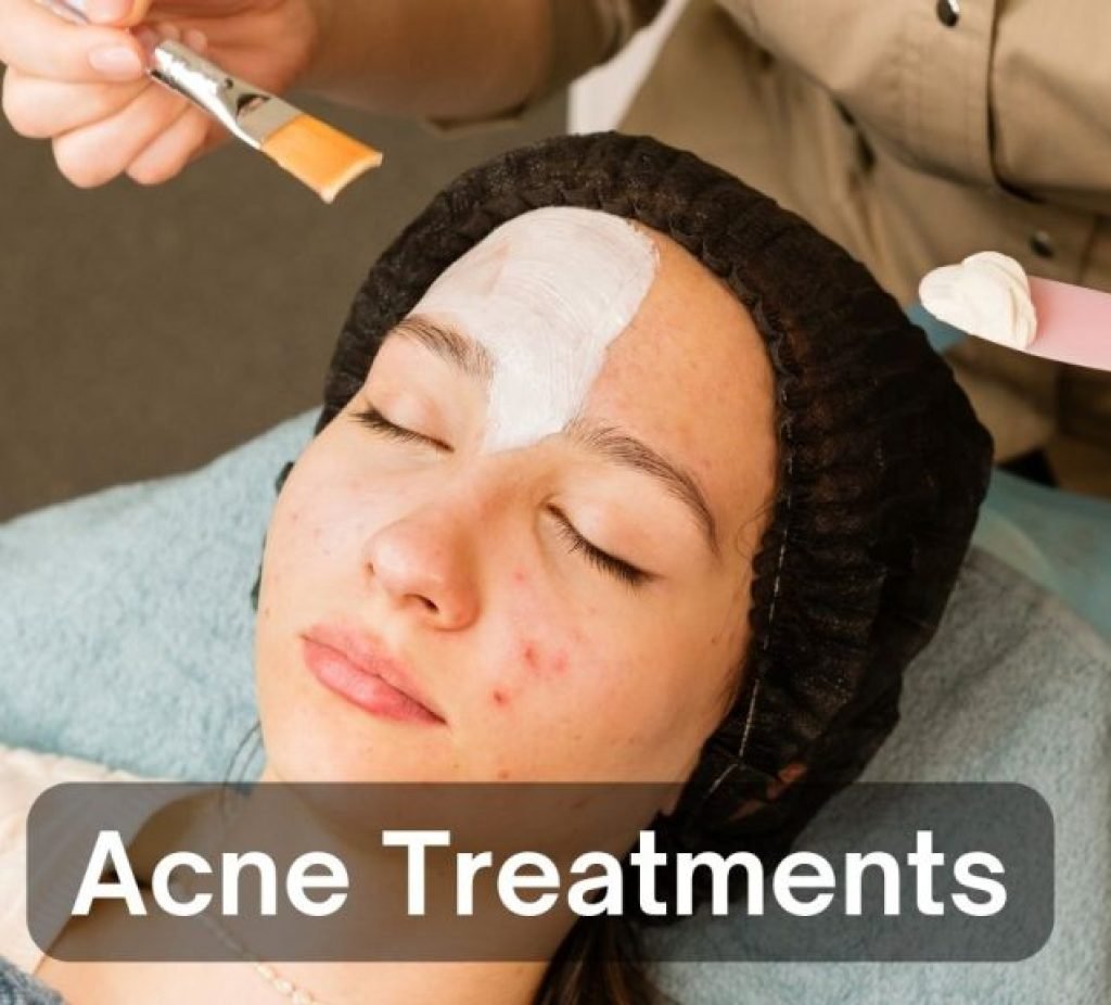 Acne Treatments
